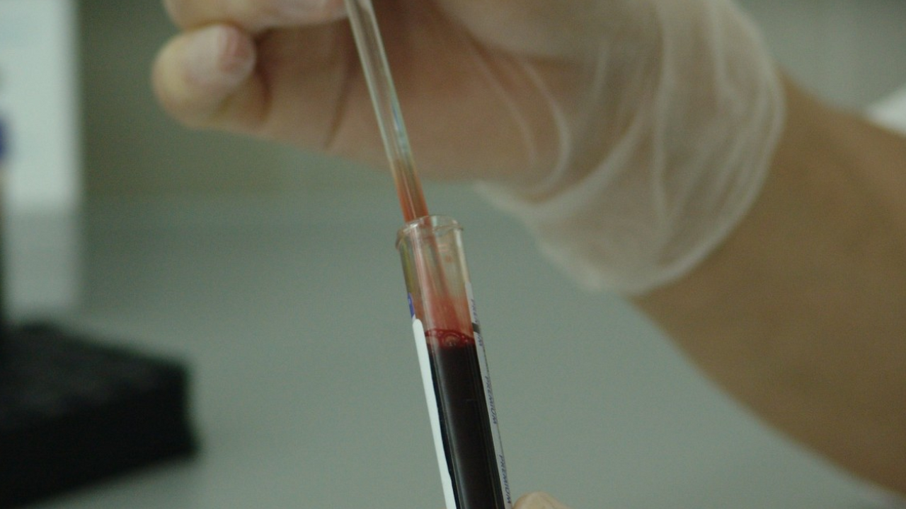 Ученые выяснили, как возраст донорской крови влияет на развитие Альцгеймера Переливание крови от пожилых доноров может уско...