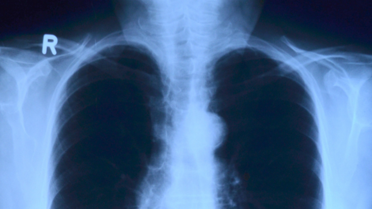 Стало известно, какую дозу облучения получают люди на рентгене Многие переживают, когда врач назначает рентген...