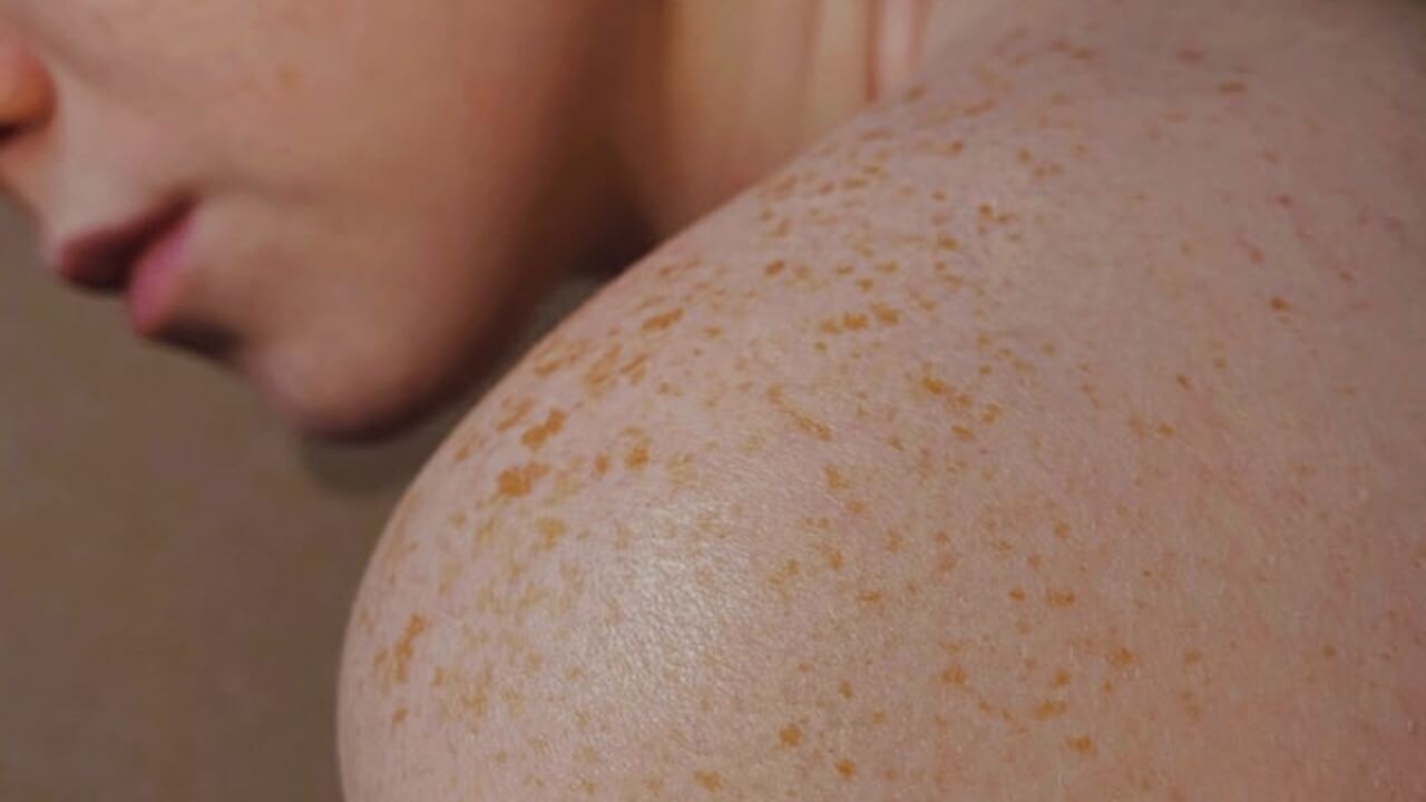 Ученые обнаружили, что меланома может одновреме...