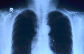 Стало известно, какую дозу облучения получают л...